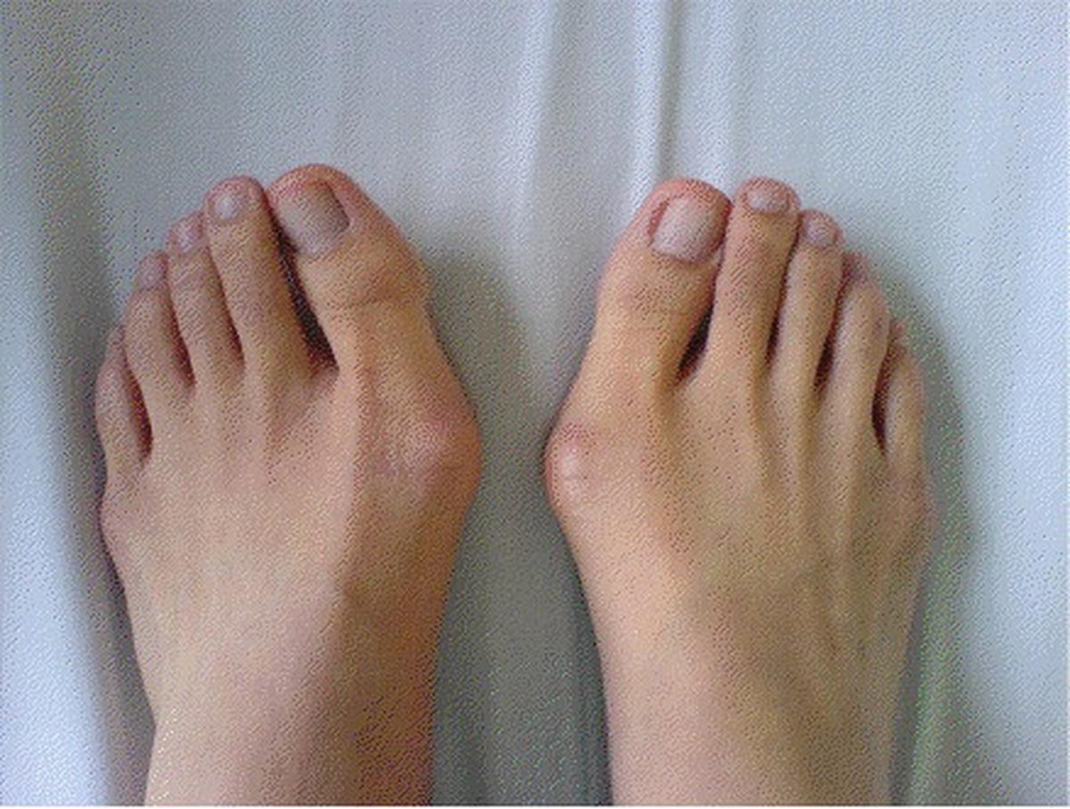 Bunion