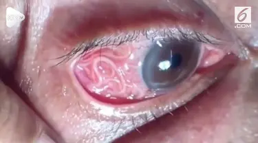 Seorang pria di India, mengaku matanya gatal dan perih. Setelah diperiksa, ternyata matanya dihinggapi cacing parasit sepanjang 15 cm.