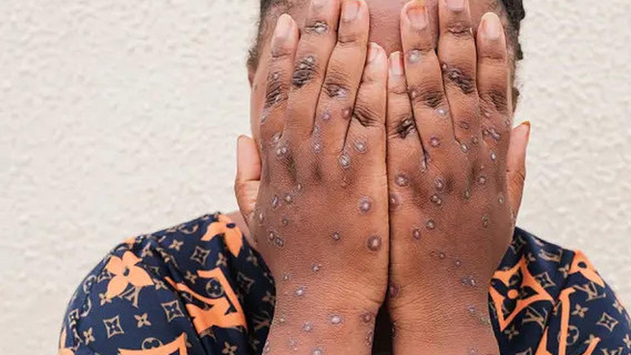 8 Senjata Rahasia yang Bisa Dilakukan untuk Menghentikan Penyebaran Mpox