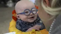 Bocah bernama Leo, pasien dengan Oculocutaneous albinisme (OCA), terlihat menggemaskan ketika mengenakan kacamata
