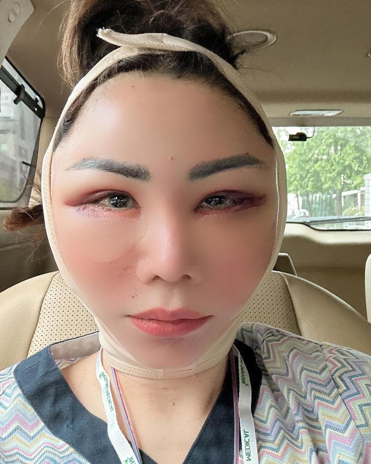 Potret Femmy Permatasari Setelah Oplas di Korea, Rela Wajah Bengkak dan 'Jelek' Dulu Pasca Lakukan 6 Prosedur Operasi