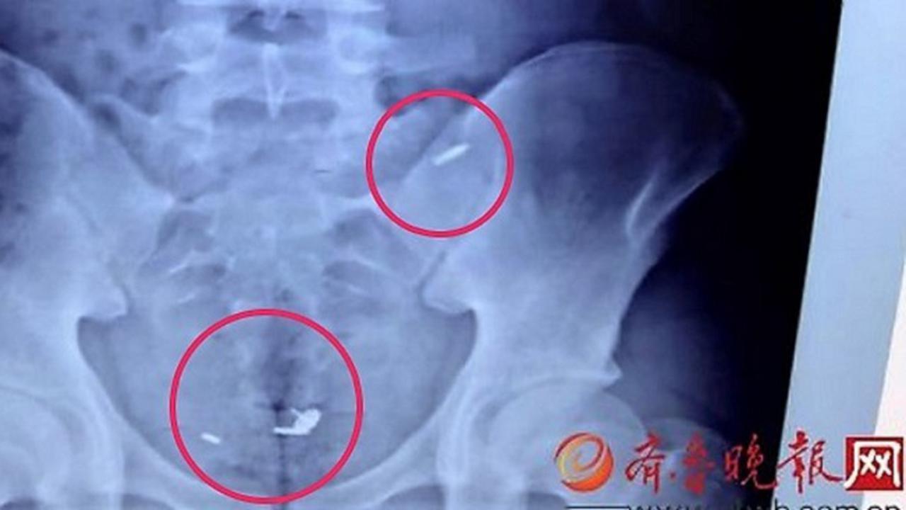 Demi Uang Rp 400 Ribu, Pemuda China Rela Telan Paku Payung