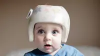 Ilustrasi bayi dengan helm koreksi bentuk. (dok. hopkinsmedicine.org)