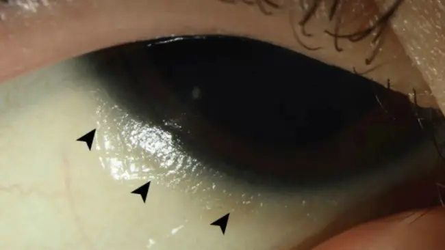 Dalam foto, anak panah berwarna hitam menunjukkan adanya titik-titik Bitot, yaitu bagian kering dan keriput pada permukaan bola mata pasien. (Sumber American Medical Association)
