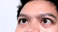 Mata Juling atau Strabismus Bisa Dialami Anak hingga Dewasa, Ini Penyebabnya