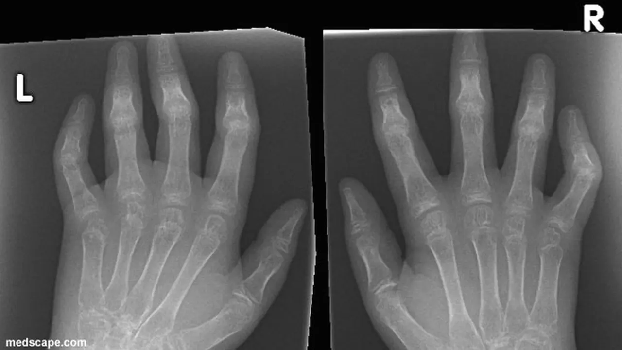osteopenia--130731b.jpg