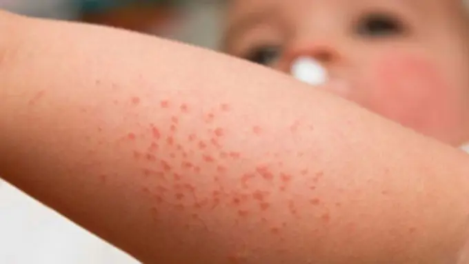 Jaga Kesehatan, Korban Virus Flu Singapura Mulai Berjatuhan