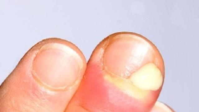 Penyebab Kuku Kuning