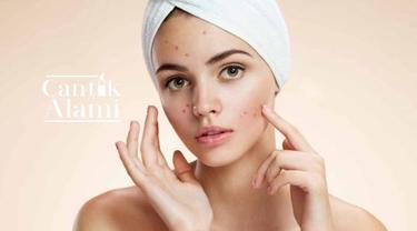 Cantik Alami Mengatasi Wajah Kemerahan Akibat Jerawat Beauty