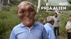 Ia berwajah alien karena orangtuanya tak punya biaya untuk berobat sedari kecil.