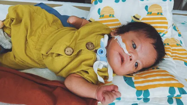 Hiro, Bayi Hiro, Moebius Syndrome, Kondisi Langka, Kondisi Tanpa Ekspresi, Tanpa Ekspresi, Bayi