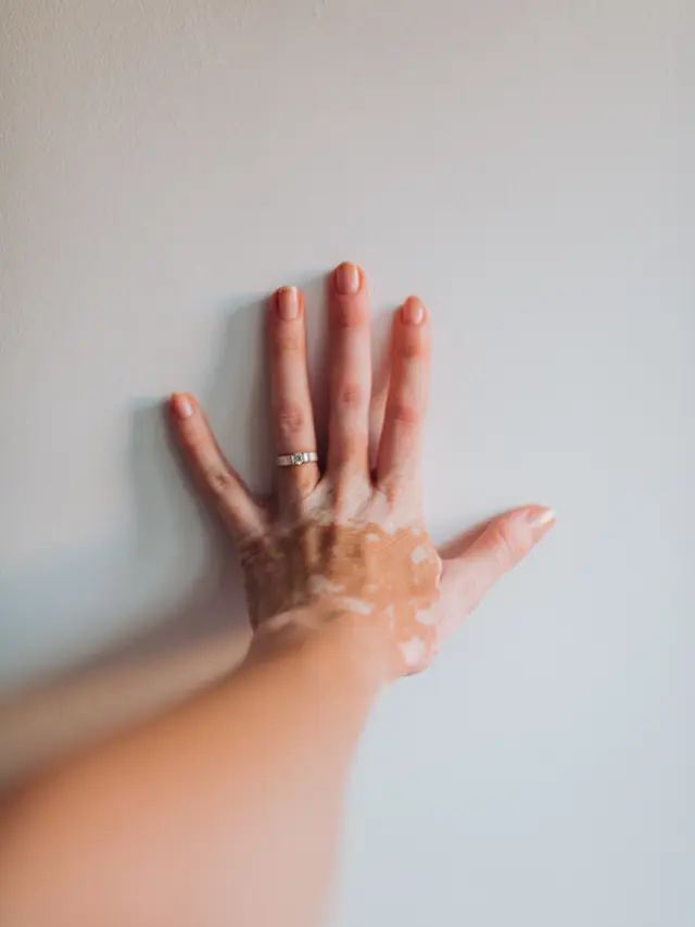 Contoh ilustrasi kulit tangan yang kering karena kondisi medis