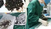 Akibat Jarang Sarapan, Perut Wanita Ini Dipenuhi Batu