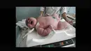 Ademilton dos Santos merupakan bayi terbesar di Brazil. Bayi yang lahir dengan berat 8 jk itu lahir melalui operasi caesar di sebuah rumah sakit di Salvador, Brazil. (Istimewa)