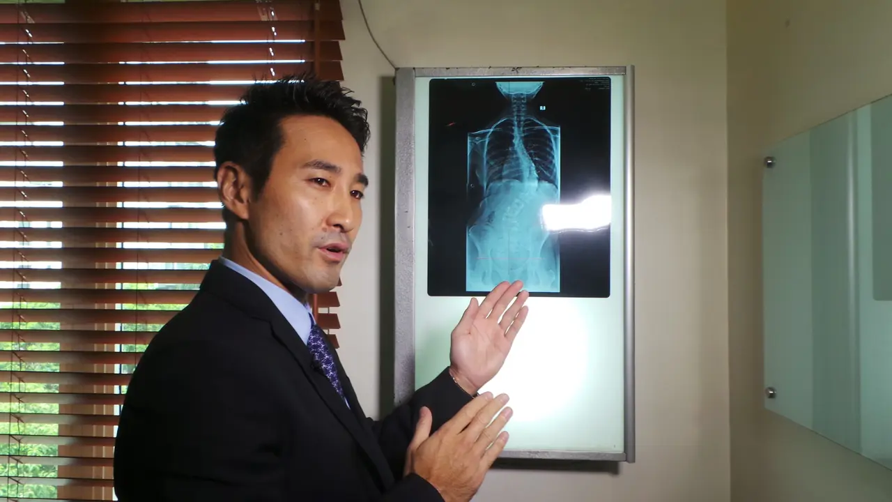 Apakah Skoliosis Pada Anak Bisa Sembuh?