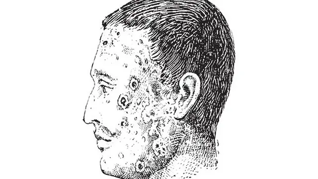 Impetigo