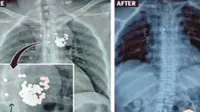 Seorang pria yang hidup selama empat tahun dengan 97 peluru di dadanya, berhasil menjalani operasi untuk mengangkat benda tersebut