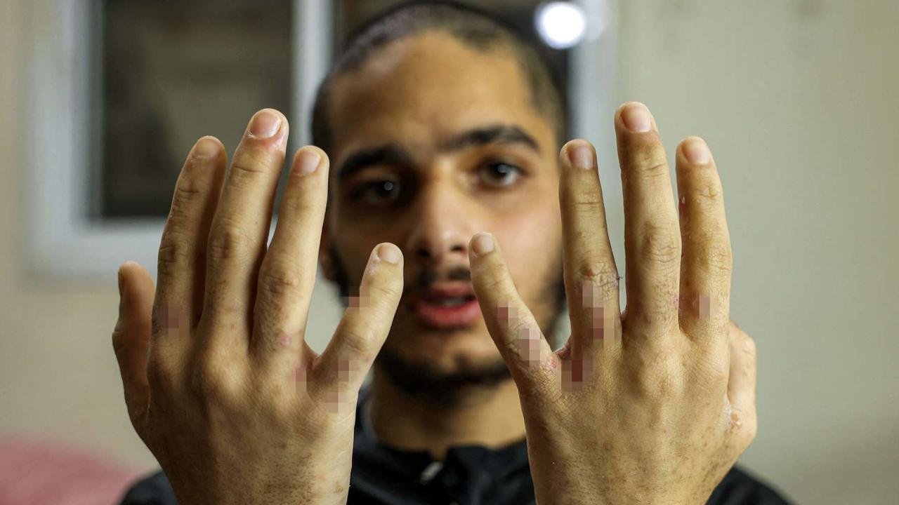 FOTO: Terungkap Kondisi Miris Tahanan Palestina usai Dibebaskan Israel, Tubuh Kurus dan Penuh Kudis