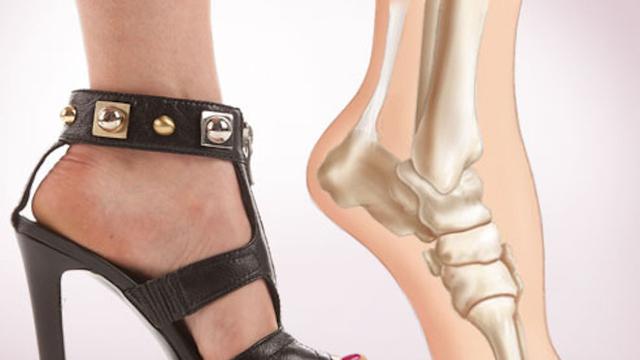 High Heels dapat Menyebabkan Cedera