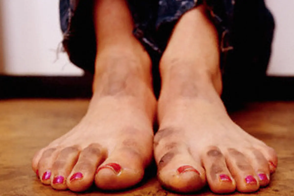 10 Tahun Tak Mandi, Tubuh Pria Ini Bau Busuk dan Dipenuhi Kutu