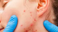 Perawatan Wajah untuk Hempaskan Bekas Jerawat Membandel, Ada 4 Treatment!