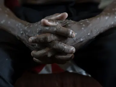 Seorang pria penderita mpox menunggu perawatan di Rumah Sakit Umum Kamituga di Kivu, Kongo Selatan, Rabu (4/9/2024). (AP Photo/Moses Sawasawa)