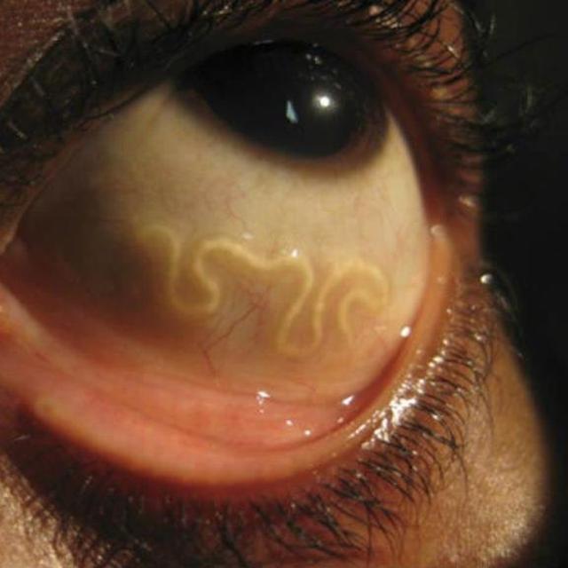 Sering Gatal Ternyata 14 Cacing Langka Bersarang Di Mata Wanita