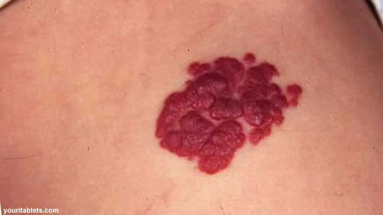 hermangioma-130710b.jpg