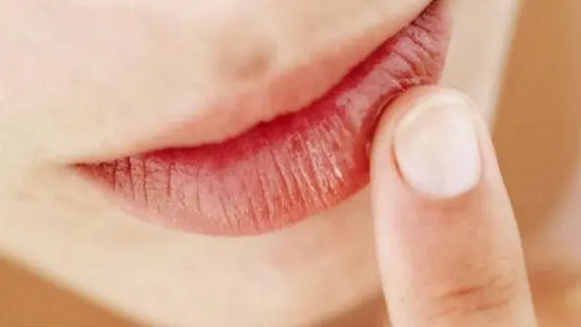 Penyebab Bibir Pecah-Pecah