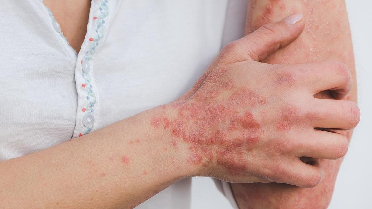 Mengenal Herpes Zoster