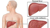Penyakit wilson merupakan gangguan genetik langka yang diakibatkan oleh menumpuknya zat tembaga di berbagai organ vital terutama hati.