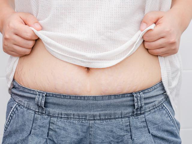 5 Cara Menghilangkan Stretch Mark Yang Membandel Lifestyle Liputan6 Com