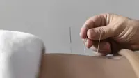 Keunggulan Akupunktur Laser dari Terapi Jarum, Salah Satunya Tak Timbulkan Rasa Sakit Berlebih. Foto: Freepik.