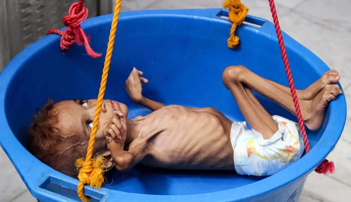 Seorang bocah yang menderita gizi buruk ditimbang di rumah sakit di Distrik Abs, Provinsi Haji, Yaman, Rabu (19/9). Konflik berkepanjangan antara pemerintah Yaman dengan pemberontak Houthi mengakibatkan 5,2 anak terancam kelaparan akut. (ESSA AHMED/AFP)