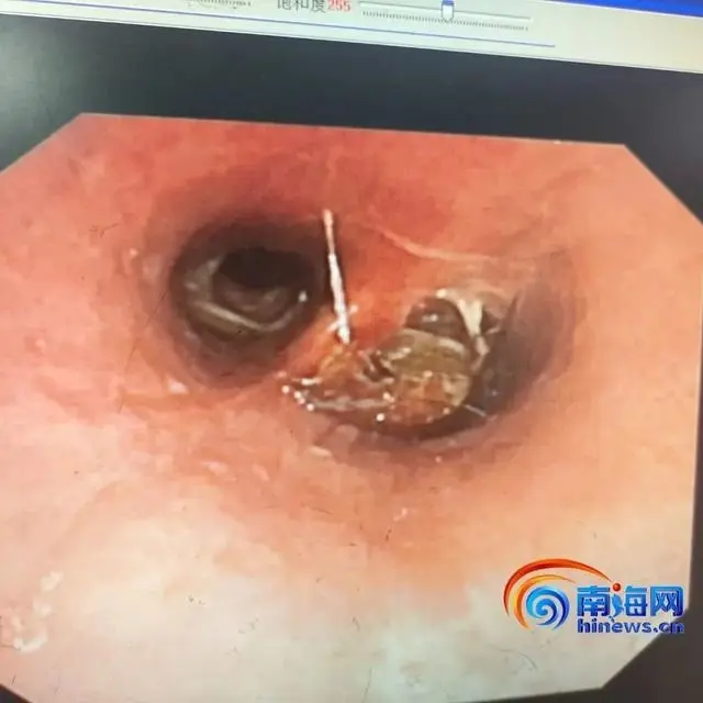 Kecoa Mati di Tenggorokan