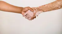 Ilustrasi vitiligo. (dok. Pexels.com/Photo by Armin Rimoldi)