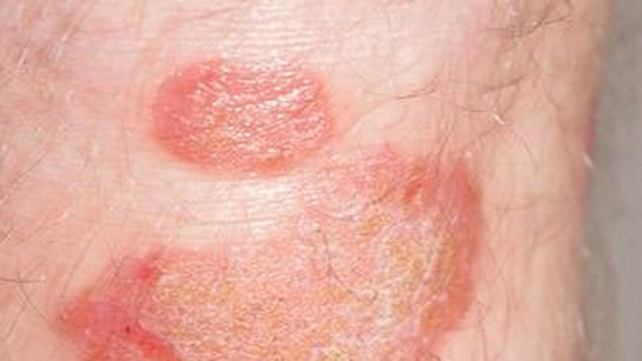 Mengenal Psoriasis Vulgaris: Pemicu, Penyebab, Gejala, dan Dampak Negatifnya
