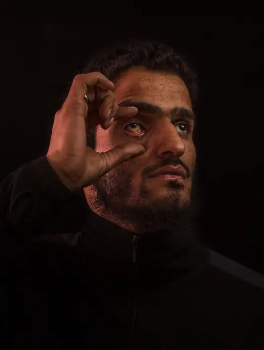 Pada 29 November 2016, Aamir Ashraf Hajam (25) berpose saat di foto di sebuah desa Baramulla, Kashmir, India. Aamir kehilangan penglihatan enam tahun lalu setelah peluru logam menghantam mata kanannya. (AP Photo / Bernat Armangue)