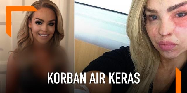 VIDEO: Jadi Korban Air Keras, Wanita Ini Jalani 250 Operasi Plastik
