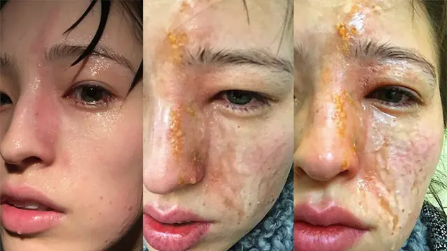 Tragis, Wajah Wanita Cantik Ini Rusak Terkena Pengharum Ruangan