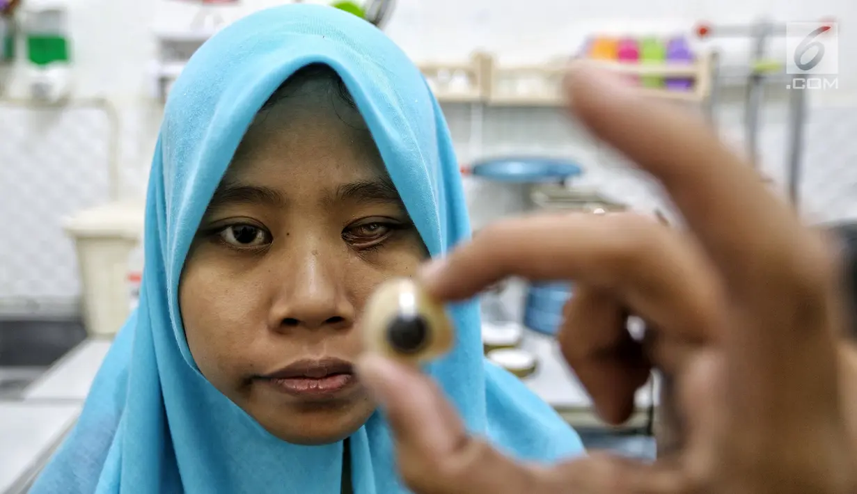 Pasien bernama Nurul siap dipasang bola mata palsu di Klinik Ilyarsi Okularis, Ciputat, Tangerang Selatan, Banten, Sabtu (3/2). Ilyasin kemudian terhubung dengan John Pacey-Lowrie, ahli pembuat bola mata palsu asal Inggris. (Liputan6.com/Fery Pradolo)