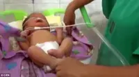 Bayi Terlahir dengan 2 Lubang Hidung Dekat Kening