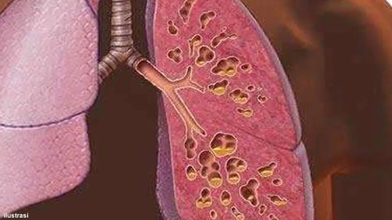 transplantasi-121220b.jpg