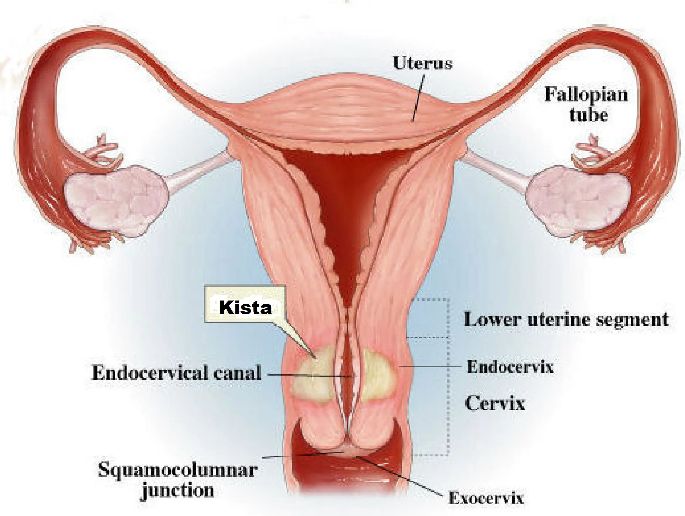 Kista. (Foto: kmuricataindonesia.com)