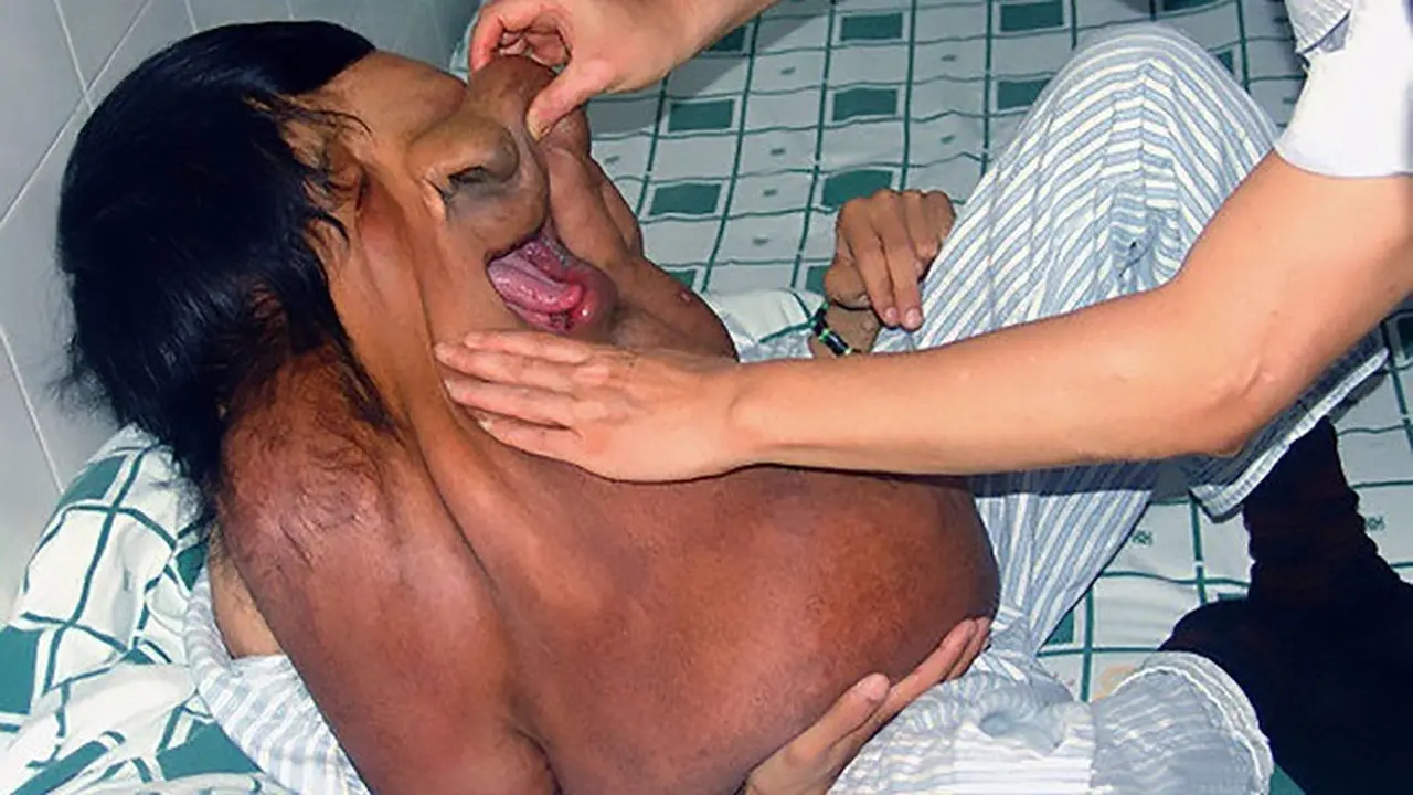 Kisah Pilu Pria Gajah, Pemilik Tumor Wajah Seberat 15 Kg