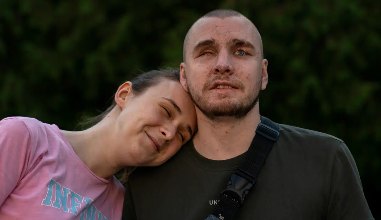 Vlada Ryabets (kiri) bersandar pada tunangannya Ivan Soroka, seorang mantan tentara Ukraina berusia 27 tahun yang buta akibat perang di sebuah pusat rehabilitasi untuk tentara yang kehilangan penglihatan mereka di medan perang dekat Rivne, Ukraina, 20 Juli 2023. (AP Photo/Jae C. Hong)