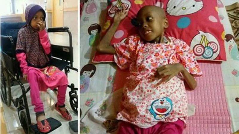 Yuk Bantu Shazia, Pejuang  Kanker Agar Bisa Transplatasi Hati 