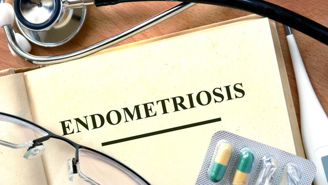 Ilustrasi Endometriosis (Foto: iStockphoto)