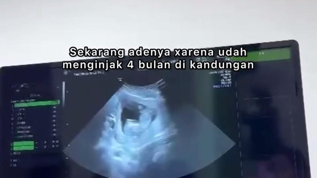 Mengandung Anak Kembar, Siti Badriah Lakukan Operasi Pengangkatan Satu Janinnya karena di Luar Rahim - Bakal Bahayakan sang Ibu