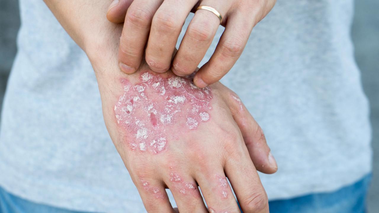 Inovasi Klinik Kecantikan Hadirkan Treatment Psoriasis untuk Keluarga, Cek Fakta Penyakit Ini Yuk!